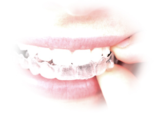 invisalign-01