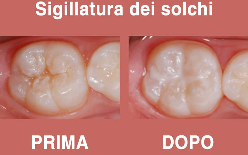 Sigillatura dei solchi per bambini